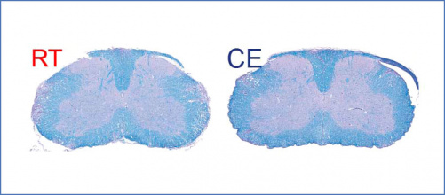 moelle_epiniere_demyelinisee_1.jpg