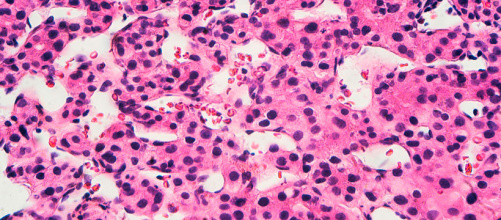 carcinome_hepatocellulaire_1.jpg